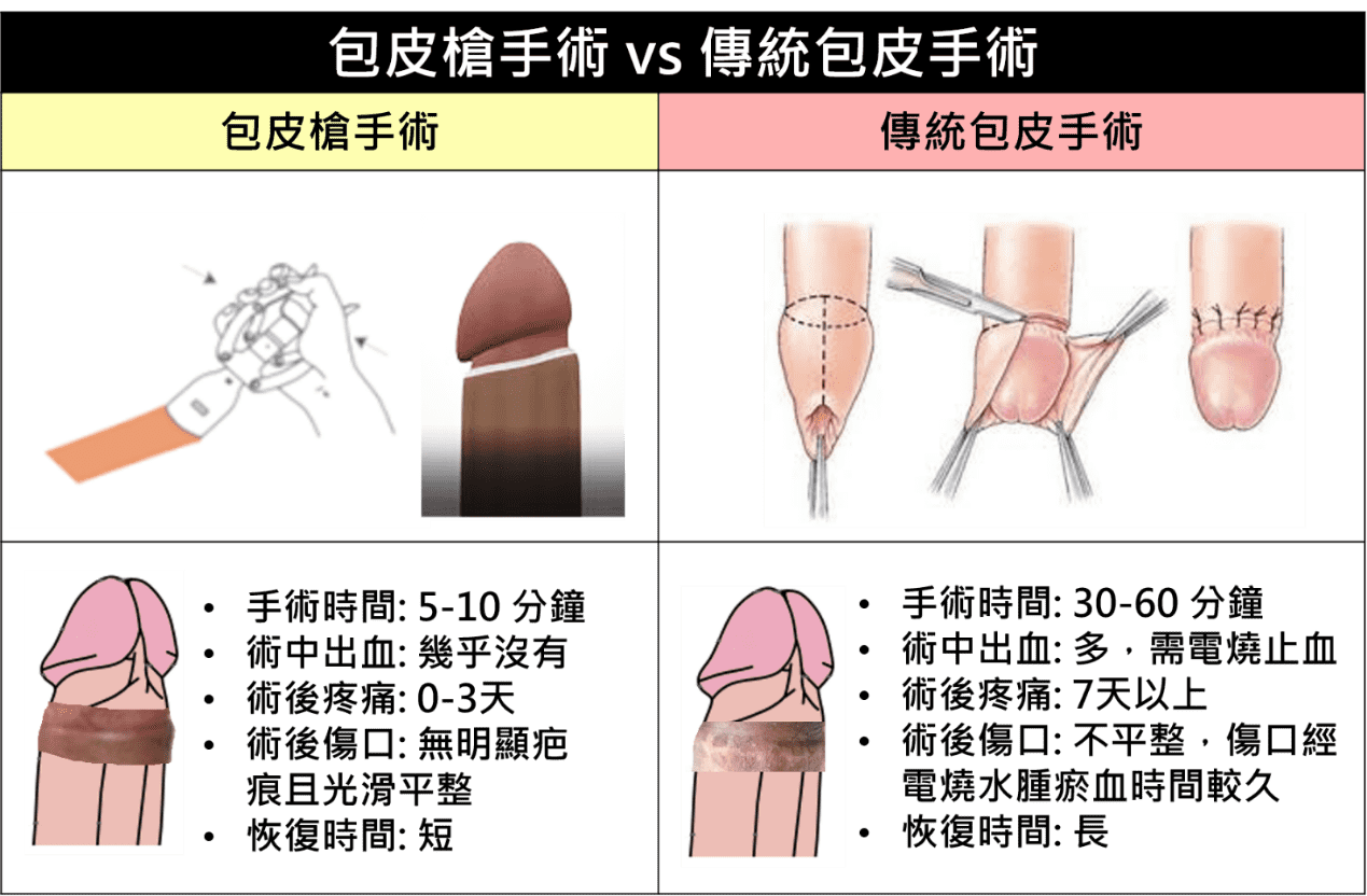 包皮槍手術與傳統包皮手術對比